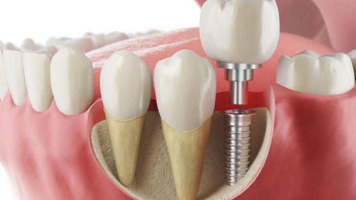 implant Tedavisi Hakkında Bilinmesi Gerekenler